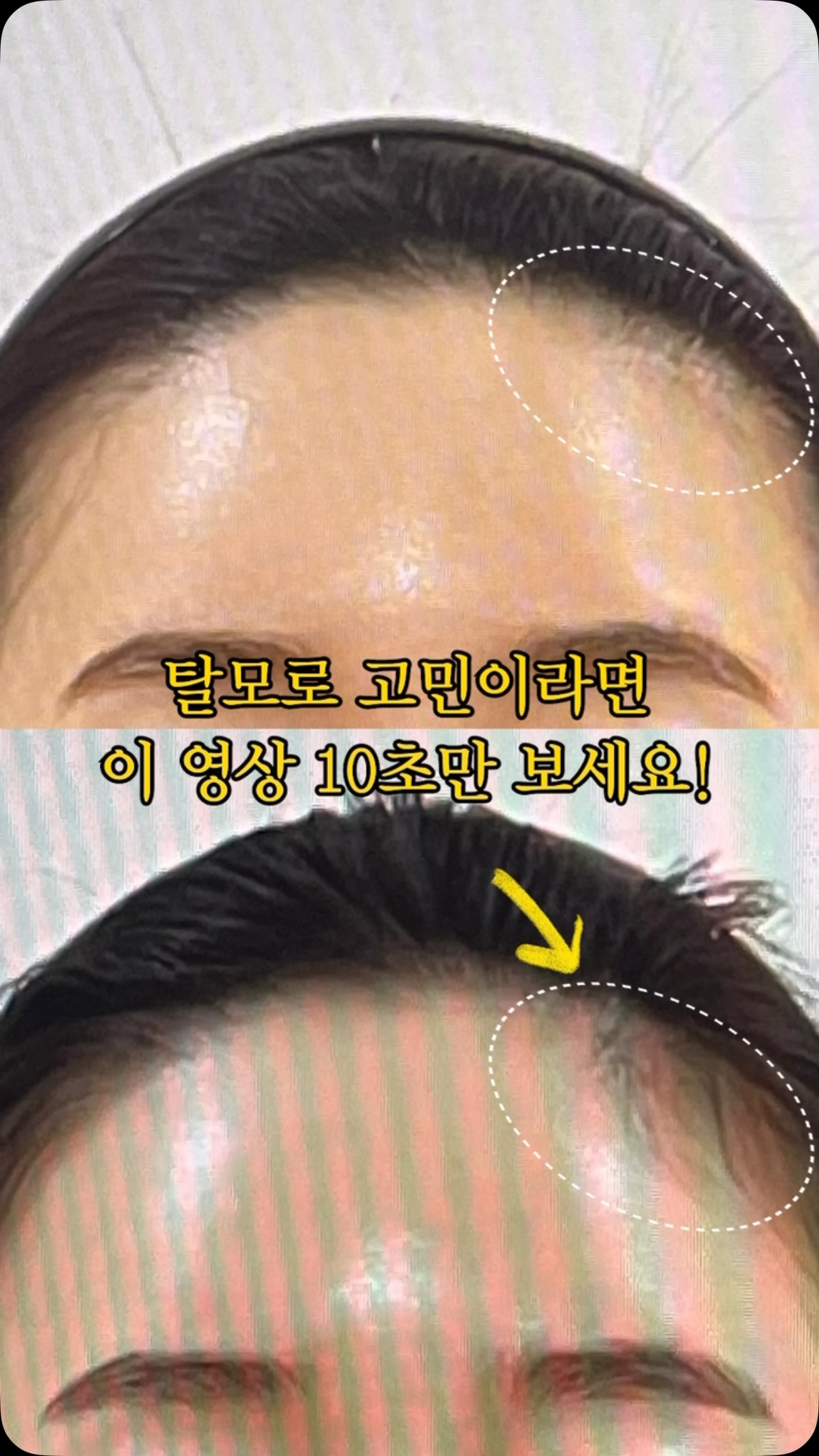 TRX2 탈모 앰플