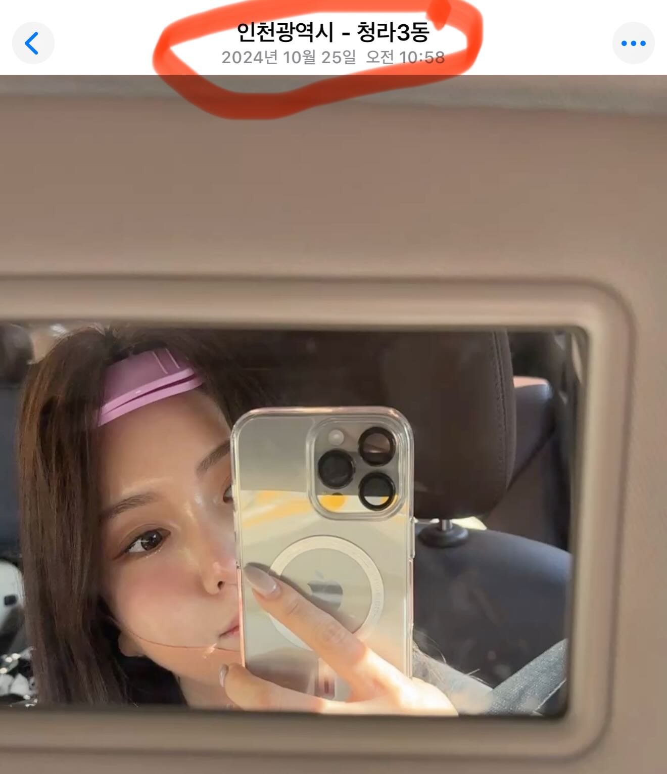 id성형외과 마이너스밴드
